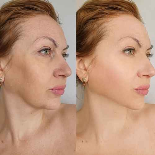 HIFU Non Surgical Facelift Woodley 