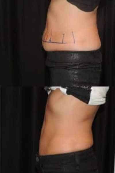 HIEMT Muscle Toning Woodley 