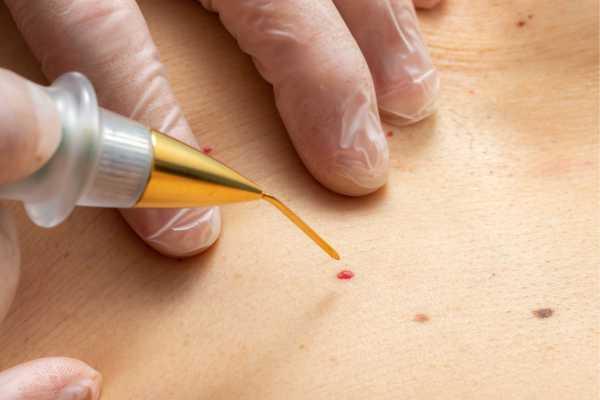 Dermatofibroma Removal Woodley  - How We Remove It