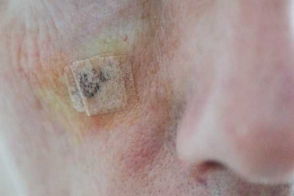 seborrheic keratoses removal Woodley 