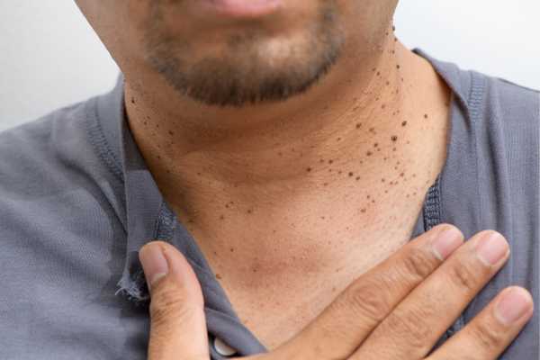 How Does Skin Tag Removal Woodley  Work?