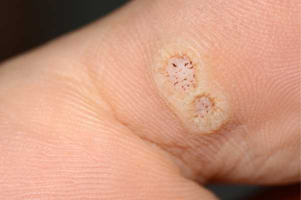 wart removal Woodley 