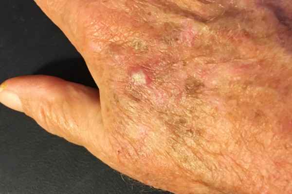 What Makes CryoPen a Safe Choice for Wart Removal Woodley ?