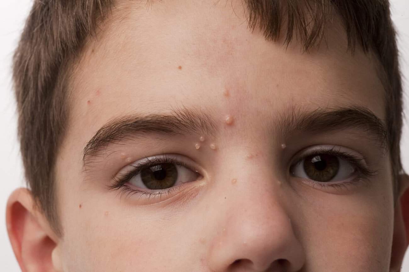 Molluscum Contagiosum Woodley , How We Remove It