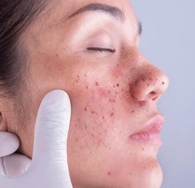 Angiofibroma Treatment Woodley 