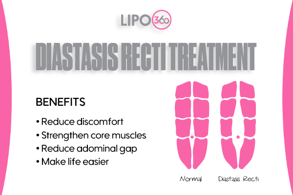LIPO360 Body Sculpt - Diastasis Recti Treatment Woodley 
