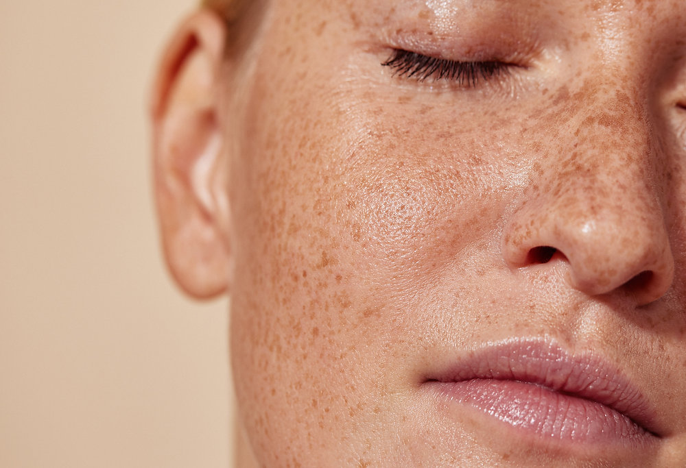 Why Is Lipo 360 Woodley  the Right Place for Ephelides Treatment?