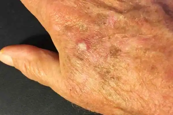 Image of Actinic keratoses Woodley  on a person hand