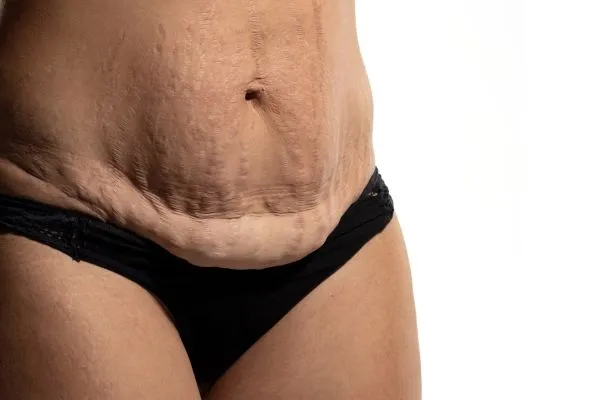 The Science of Skin Tightening 1 The science behind skin tightening Woodley picture of a woman's sagging skin on the stomach